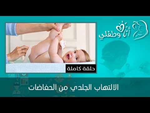 بالفيديو نصائح لحماية الأطفال من الالتهاب الجلدي